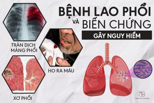 Benh Lao Phoi 01